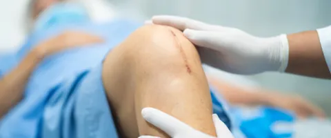 Osgood-Schlatter Disease Surgery: Success Rates, Risks, Recovery & Cost