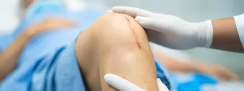 Osgood-Schlatter Disease Surgery: Success Rates, Risks, Recovery & Cost